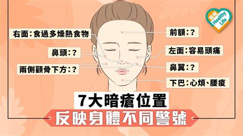 額頭 暗瘡|【暗瘡位置】不同代表什麼？中醫教如何處理及預防